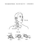 NERVE STIMULATOR SYSTEM diagram and image