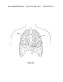 CARDIAC PACING SENSING AND CONTROL diagram and image