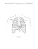 CARDIAC PACING SENSING AND CONTROL diagram and image