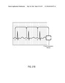 CARDIAC PACING SENSING AND CONTROL diagram and image