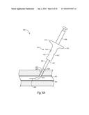 CLOSURE DEVICES, SYSTEMS, AND METHODS diagram and image