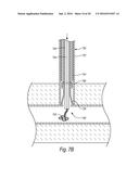 CLOSURE DEVICES, SYSTEMS, AND METHODS diagram and image