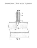 CLOSURE DEVICES, SYSTEMS, AND METHODS diagram and image