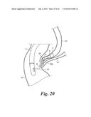 BODY CAVITY FOREIGN MATTER CAPTURE INSTRUMENT diagram and image