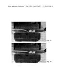 BODY CAVITY FOREIGN MATTER CAPTURE INSTRUMENT diagram and image