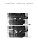 BODY CAVITY FOREIGN MATTER CAPTURE INSTRUMENT diagram and image