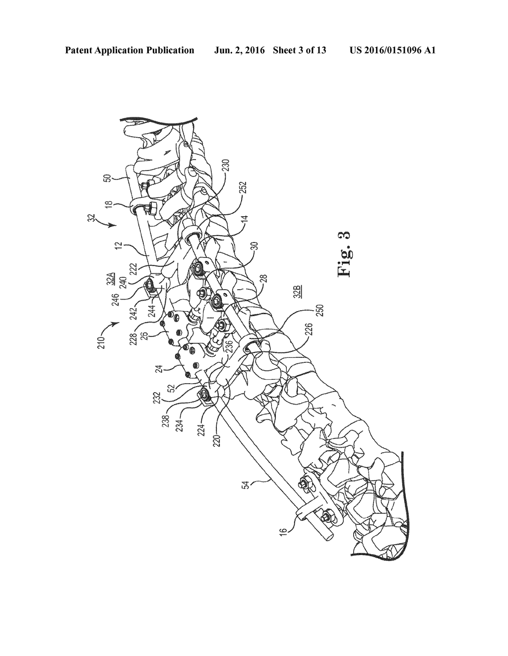 SPINAL CORRECTION ADJUSTMENT SYSTEMS AND METHODS - diagram, schematic, and image 04