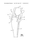 Implants/Procedures Related to Tibial Tuberosity Advancement diagram and image