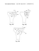 METHODS AND DEVICES FOR BONE PREPARATION diagram and image