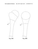 METHODS AND DEVICES FOR BONE PREPARATION diagram and image