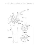 METHODS AND DEVICES FOR BONE PREPARATION diagram and image