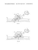 SYSTEM FOR ANCHORING MEDICAL DEVICES diagram and image