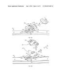 SYSTEM FOR ANCHORING MEDICAL DEVICES diagram and image