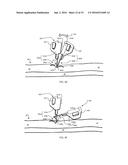 SYSTEM FOR ANCHORING MEDICAL DEVICES diagram and image