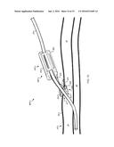 SYSTEM FOR ANCHORING MEDICAL DEVICES diagram and image