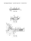 Systems And Methods For Unobstructed Visualization And Ablation diagram and image