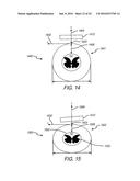 SPINAL CORD STIMULATION GUIDANCE SYSTEM AND METHOD OF USE diagram and image