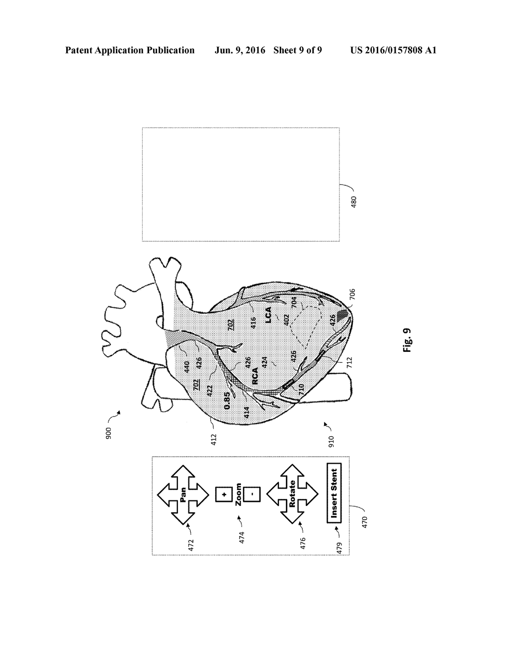 INTERACTIVE PHYSIOLOGIC DATA AND INTRAVASCULAR IMAGING DATA AND ASSOCIATED     DEVICES, SYSTEMS AND METHODS - diagram, schematic, and image 10