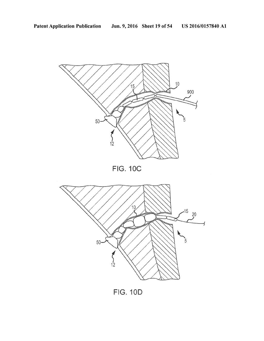 FISTULA TREATMENT DEVICES AND RELATED METHODS - diagram, schematic, and image 20