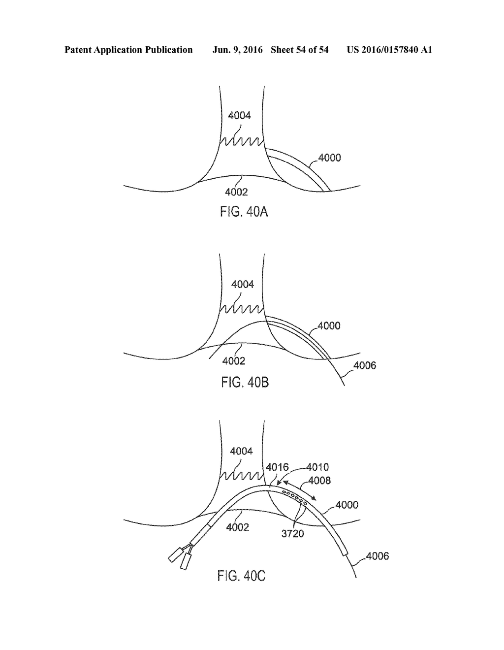 FISTULA TREATMENT DEVICES AND RELATED METHODS - diagram, schematic, and image 55