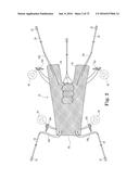 METHOD OF FIXATING AN IMPLANTABLE MATERIAL IN A PATIENT diagram and image