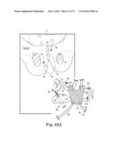 METHOD OF FIXATING AN IMPLANTABLE MATERIAL IN A PATIENT diagram and image