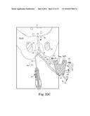 METHOD OF FIXATING AN IMPLANTABLE MATERIAL IN A PATIENT diagram and image