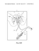 METHOD OF FIXATING AN IMPLANTABLE MATERIAL IN A PATIENT diagram and image