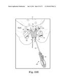 METHOD OF FIXATING AN IMPLANTABLE MATERIAL IN A PATIENT diagram and image