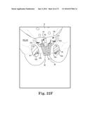 METHOD OF FIXATING AN IMPLANTABLE MATERIAL IN A PATIENT diagram and image