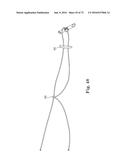 METHOD OF FIXATING AN IMPLANTABLE MATERIAL IN A PATIENT diagram and image