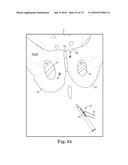 METHOD OF FIXATING AN IMPLANTABLE MATERIAL IN A PATIENT diagram and image