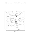 METHOD OF FIXATING AN IMPLANTABLE MATERIAL IN A PATIENT diagram and image