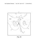 METHOD OF FIXATING AN IMPLANTABLE MATERIAL IN A PATIENT diagram and image