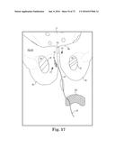 METHOD OF FIXATING AN IMPLANTABLE MATERIAL IN A PATIENT diagram and image