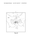 METHOD OF FIXATING AN IMPLANTABLE MATERIAL IN A PATIENT diagram and image