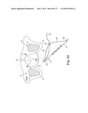 METHOD OF FIXATING AN IMPLANTABLE MATERIAL IN A PATIENT diagram and image