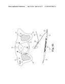 METHOD OF FIXATING AN IMPLANTABLE MATERIAL IN A PATIENT diagram and image