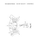 METHOD OF FIXATING AN IMPLANTABLE MATERIAL IN A PATIENT diagram and image