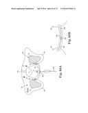 METHOD OF FIXATING AN IMPLANTABLE MATERIAL IN A PATIENT diagram and image