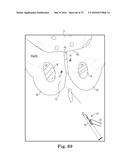 METHOD OF FIXATING AN IMPLANTABLE MATERIAL IN A PATIENT diagram and image