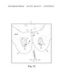 METHOD OF FIXATING AN IMPLANTABLE MATERIAL IN A PATIENT diagram and image