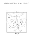 METHOD OF FIXATING AN IMPLANTABLE MATERIAL IN A PATIENT diagram and image