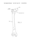 METHOD AND APPARATUS FOR RE-ATTACHING THE LABRUM TO THE ACETABULUM     INCLUDING THE PROVISION AND USE OF A NOVEL SUTURE ANCHOR SYSTEM diagram and image