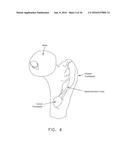 METHOD AND APPARATUS FOR RE-ATTACHING THE LABRUM TO THE ACETABULUM     INCLUDING THE PROVISION AND USE OF A NOVEL SUTURE ANCHOR SYSTEM diagram and image