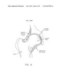 METHOD AND APPARATUS FOR RE-ATTACHING THE LABRUM TO THE ACETABULUM     INCLUDING THE PROVISION AND USE OF A NOVEL SUTURE ANCHOR SYSTEM diagram and image