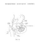 METHOD AND APPARATUS FOR RE-ATTACHING THE LABRUM TO THE ACETABULUM     INCLUDING THE PROVISION AND USE OF A NOVEL SUTURE ANCHOR SYSTEM diagram and image