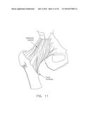 METHOD AND APPARATUS FOR RE-ATTACHING THE LABRUM TO THE ACETABULUM     INCLUDING THE PROVISION AND USE OF A NOVEL SUTURE ANCHOR SYSTEM diagram and image