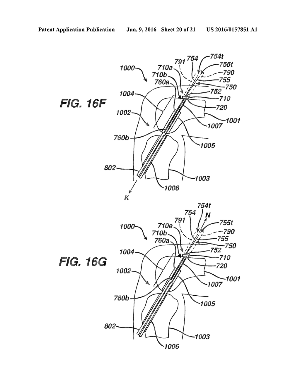 IMPLANT HAVING ADJUSTABLE FILAMENT COILS - diagram, schematic, and image 21