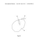 IMPLANT PLACEMENT SYSTEMS, DEVICES AND METHODS diagram and image